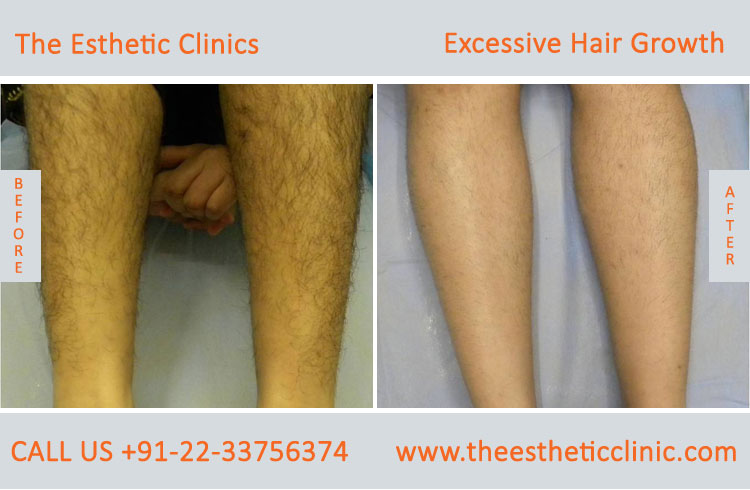Excessive Hair Growth Removal Treatment before after photos in mumbai india (8)